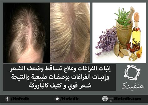أفضل علاج تساقط الشعر بالاعشاب