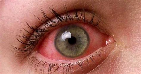 أمراض العيون