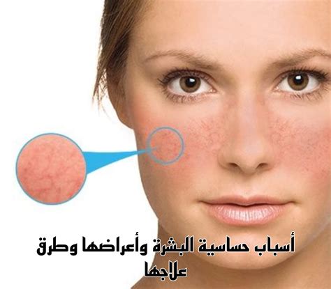 حل علاج حساسية الوجه