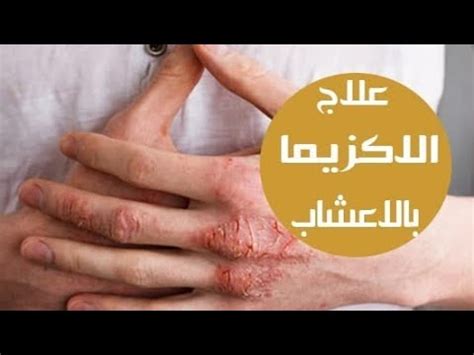 علاج الأكزيما بالأعشاب