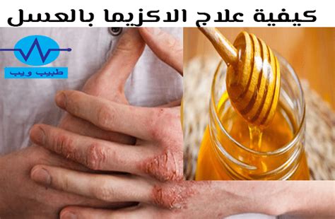 علاج الإكزيما بالعسل مجرب، تعد الإكزيما واحدة من الأمراض الجلدية التي تصيب جلد المرء وهي دوماً ما تكون معدية لهذا ينصح أن أي شخص يعاني من
