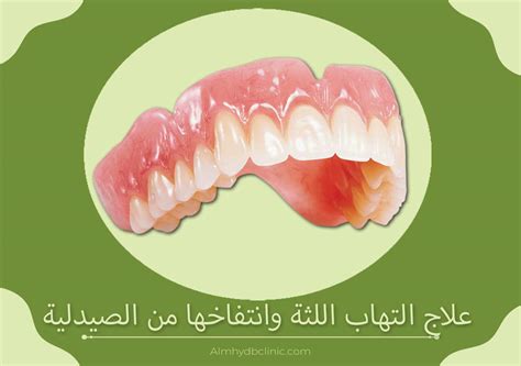 علاج التهاب اللثة وانتفاخها من الصيدلية، يساعد العلاج  كل من يعاني من آلام اللثة أو النزيف على التخلص من ذلك بشكل تام