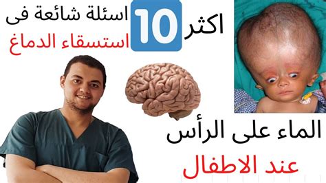 علاج مرض المخ والعصب