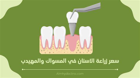 كم سعر زراعة الاسنان في المهيدب في السعودية