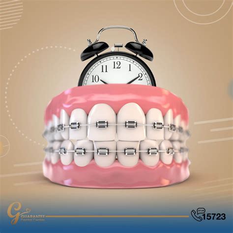 مدة تقويم الأسنان تعتمد على العوامل