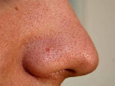 ممكن ان يظهر بعض البثور المختلفة والفقعات على الجلد في المنطقة المصابةممكن ان يسبب تشقق في الجلد وجفافتسبب حكة الجلد ظهور البقع المختلفة