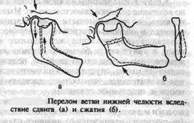  Щілина перелому