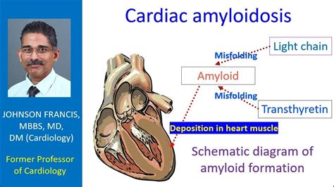 Amyloid Heart Disease Symptoms