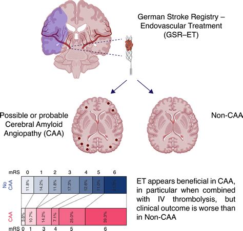 Amyloidosis And Stroke