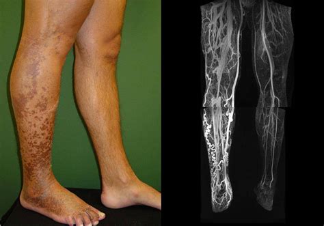 Arteriovenous Malformation In Leg
