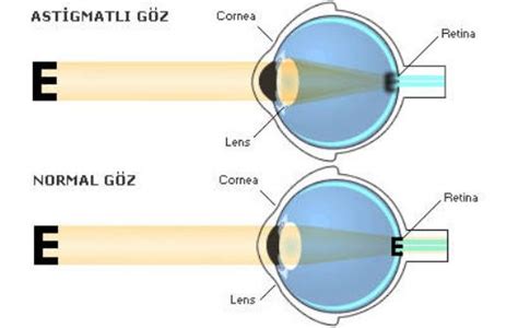 Astigmat kaç yaşa kadar ilerler