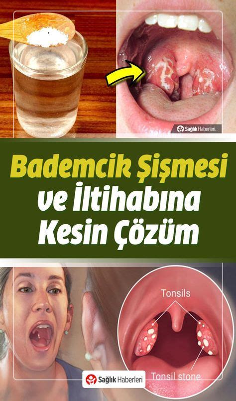 Bademcik iltihabı karabiber