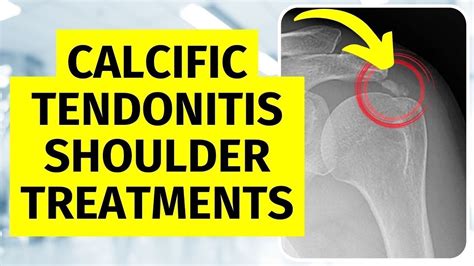 Best Treatment For Calcific Tendonitis