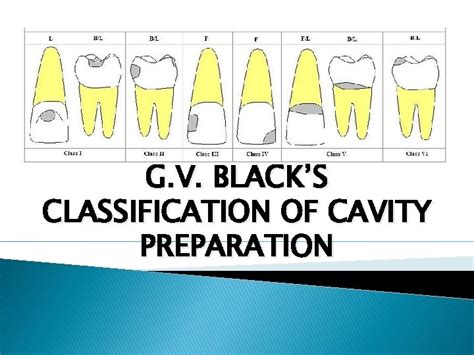 Blacks Dental Classification