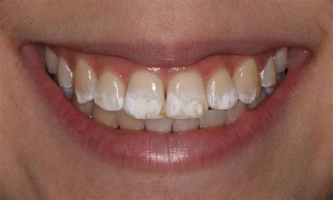 Blotchy Teeth After Whitening