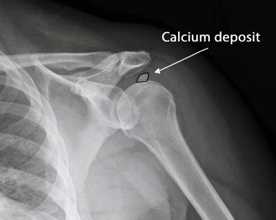 Break Up Shoulder Calcium Deposit