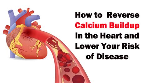 Calcium Deposit In Heart Levels