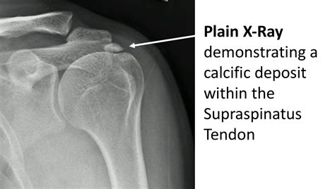 Calcium Deposit In Tendon Shoulder