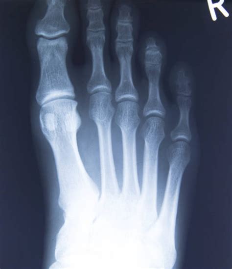 Calcium Deposits On Foot Symptoms