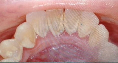 Calcium On Teeth Build Up