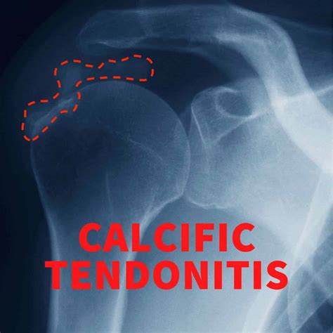 Calcium Tendonitis And Extreme Pain
