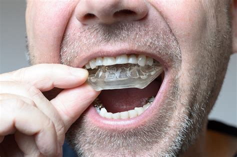 Can Night Guard Damage Teeth
