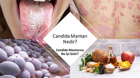 Candida mantarı nedir belirtileri