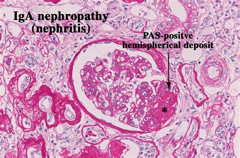 Causes Of Glomerular Iga Deposition Causes Of Glomerular Iga Deposition