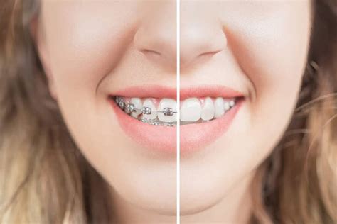 Ceramic Braces Before And After