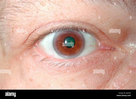 Cholesterol Deposition In Eye