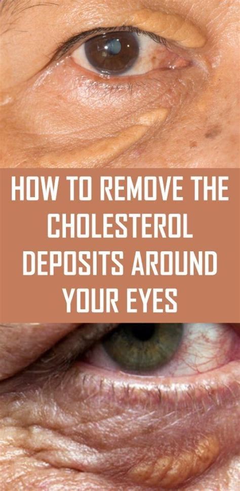 Cholesterol Under Eyes Images