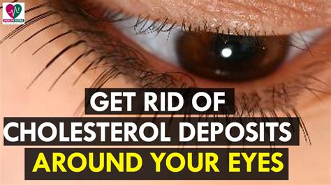 Cholesterol Under Eyes Images