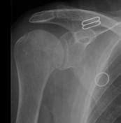 Cppd Arthropathy Shoulder