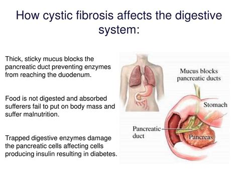 Cystic Fibrosis And Bowel Obstruction