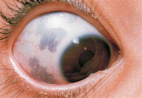 Dark Spot On Cornea