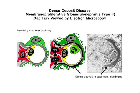 Dense Deposit Disease Treatment