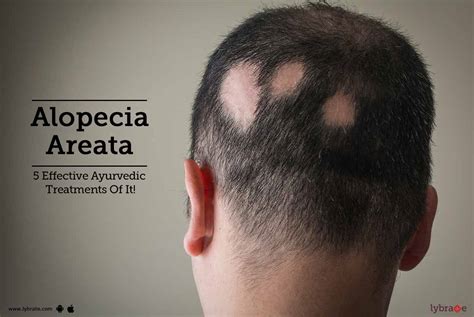 Dermovate alopecia areata