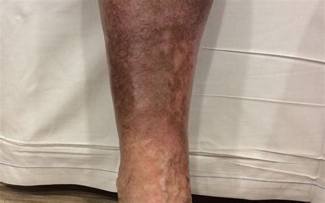 Discolored Skin On Lower Legs