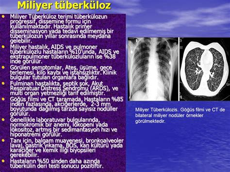 Dissemine tüberküloz