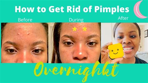 Does Acne Star Remove Pimple Marks