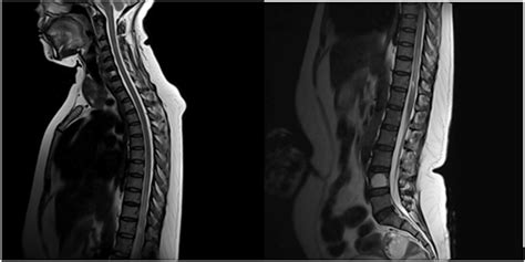 Fat Deposits In Spinal Column