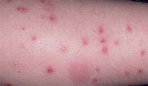 Flea Bites Pictures On Humans
