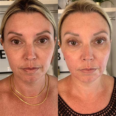Forma Treatment Before And After