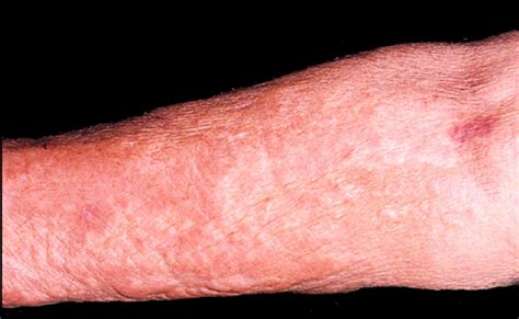Gadolinium Deposition Disease Skin