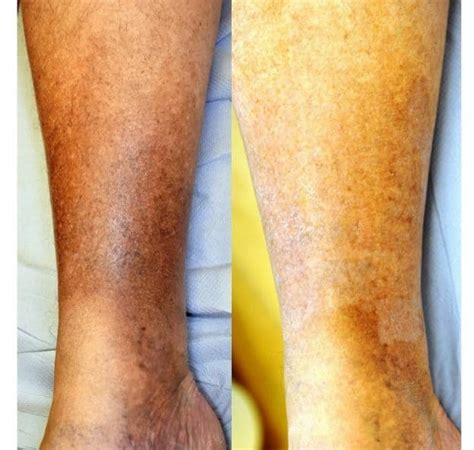 Hemosiderin Staining In Legs Treatment