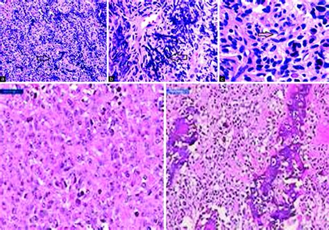 Histiocytic Deposition Nedir Histiocytic Deposition Nedir