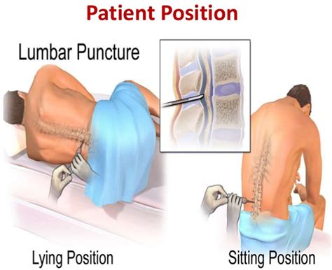 How Long Does A Lumbar Puncture Take