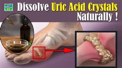 How To Dissolve Uric Acid Crystals