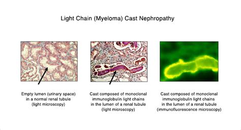 Kappa Light Chain Deposition Disease