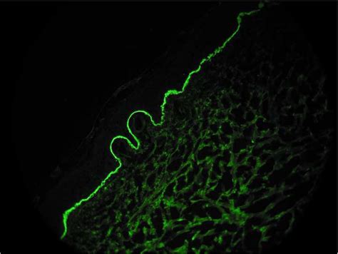 Linear Deposition Of Igg On Basement Membrane